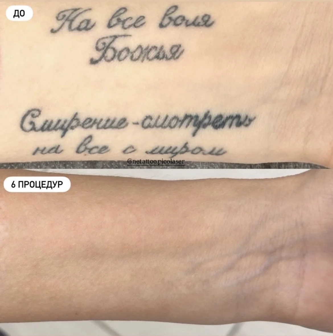 Свидание тату лазером