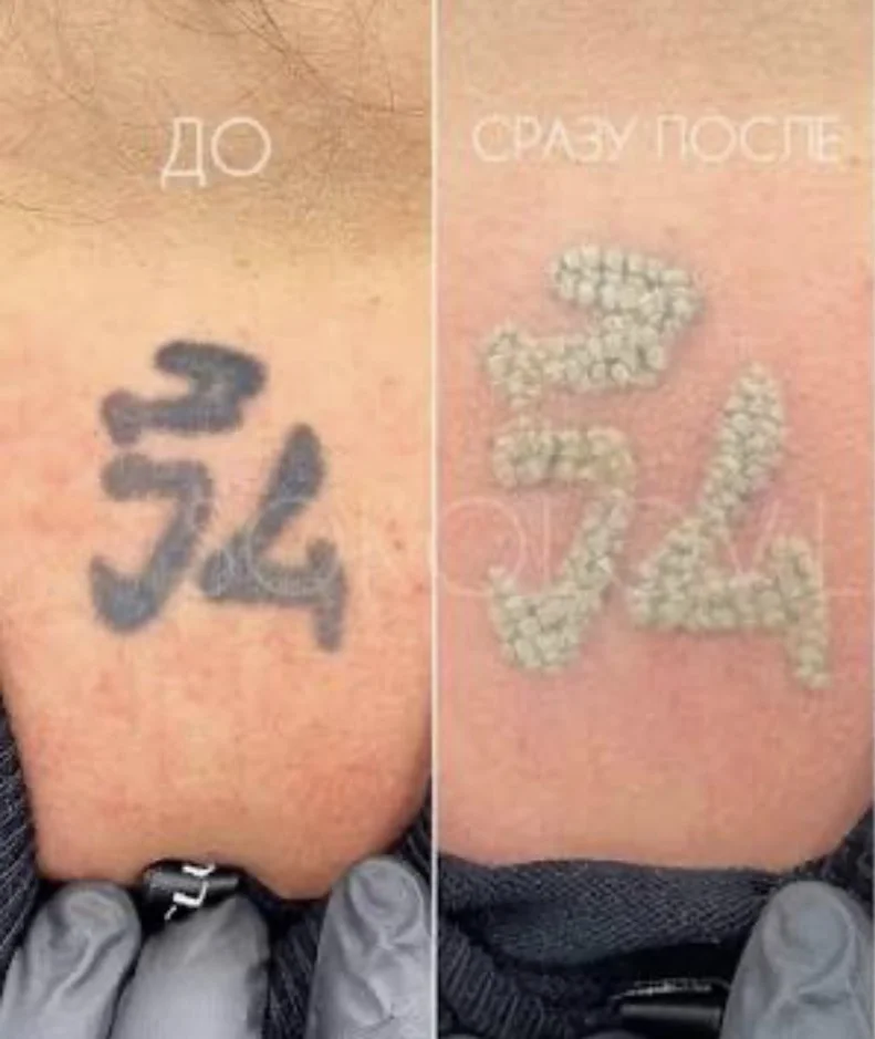 Тату сразу после лазера